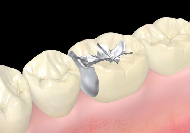メタルフリーとは