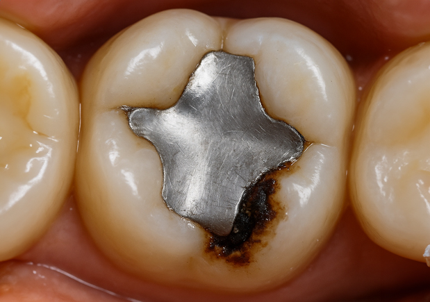 銀歯による二次う蝕