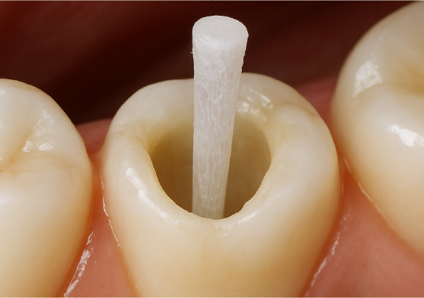 ファイバーコア