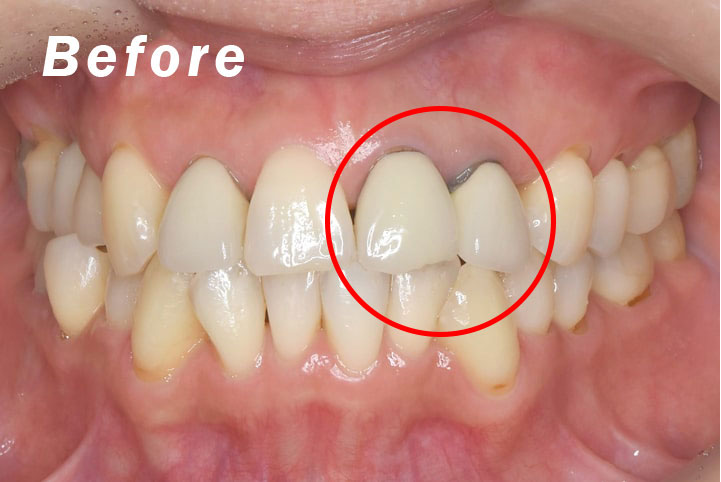 オールセラミッククラウン(IPS e-maxオールセラミック使用)の6本セットで治療Before