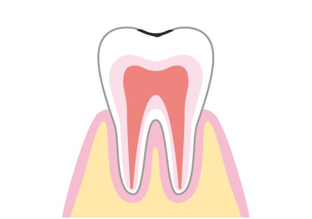 初期虫歯の治療