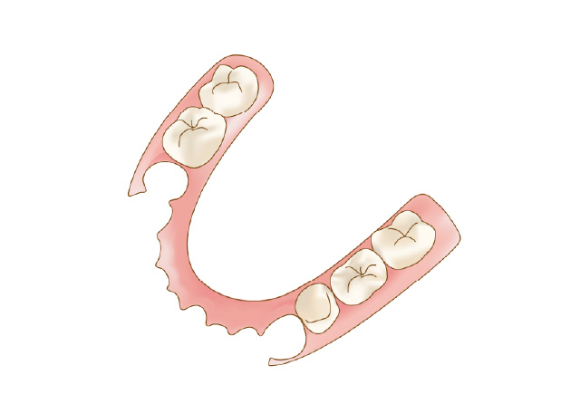 ノンクラスプ義歯