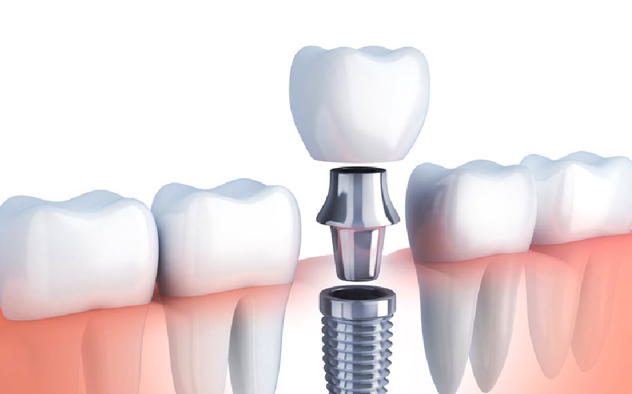 インプラントの画像