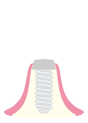 インプラント体埋入のイラスト