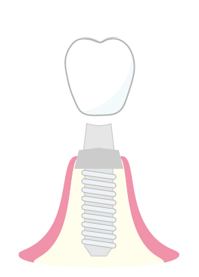 上部構造 取付のイラスト