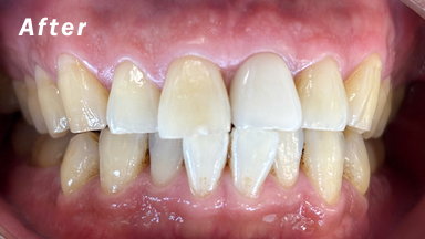 症例のafter画像