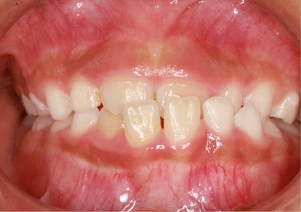 反対咬合（下顎前突）