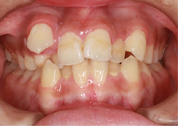 叢生（そうせい）