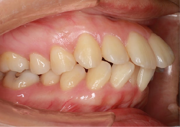 出っ歯（上顎前突）