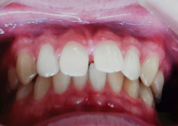 すきっ歯（正中離開）