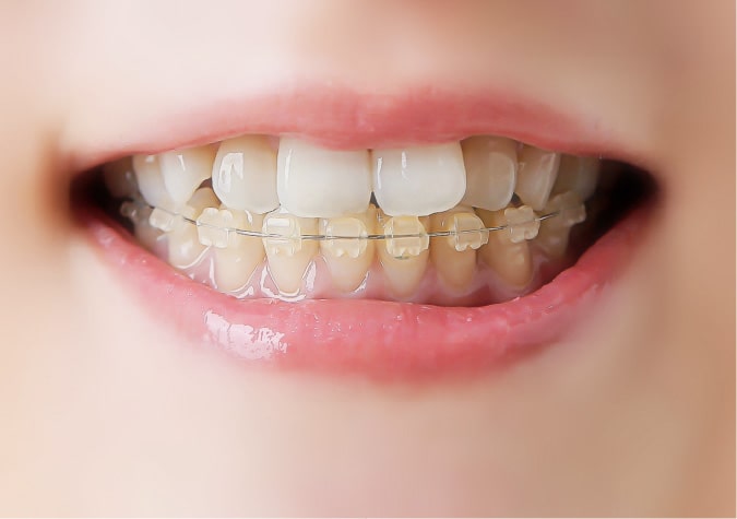 審美ブラケット矯正