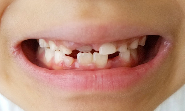 4～６歳　混合歯