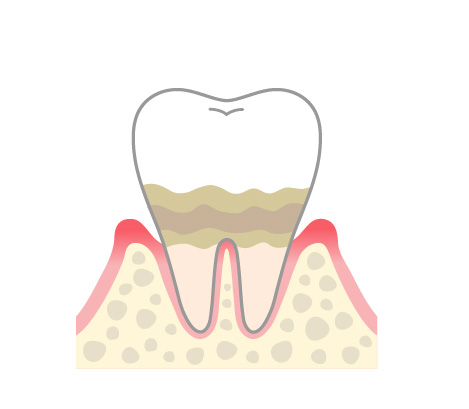 軽度歯周病