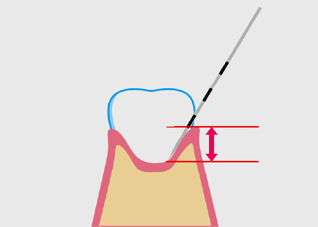 03.歯周ポケットの測定