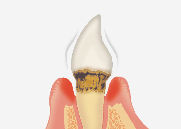 04.歯の動揺度の確認