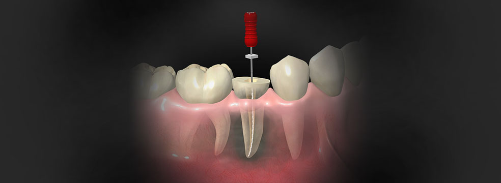再発リスクの少ない根管治療