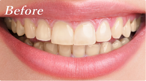 ホワイトニングbefore