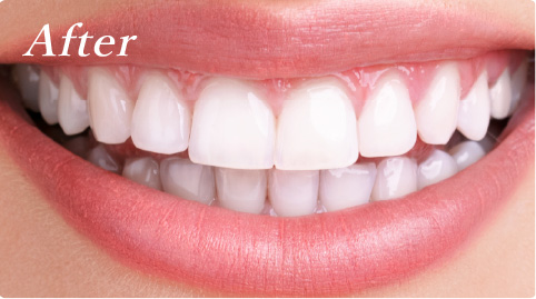 ホワイトニングafter